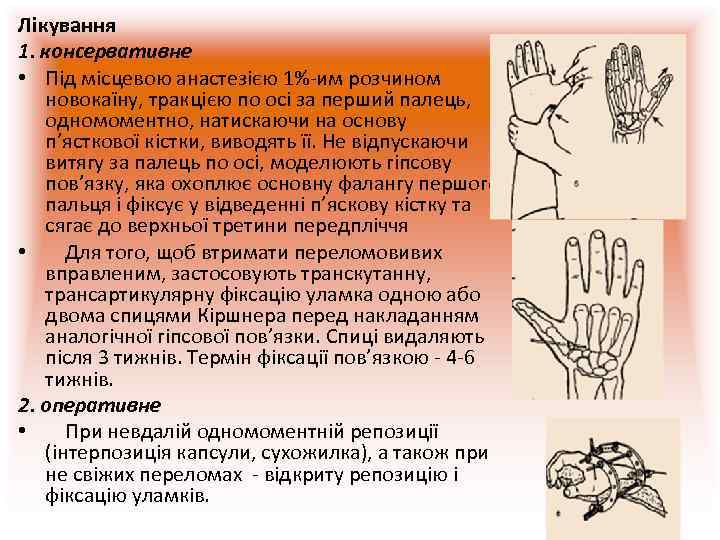 Лікування 1. консервативне • Під місцевою анастезією 1%-им розчином новокаїну, тракцією по осі за