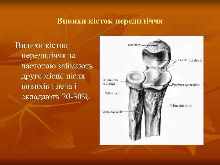    Вивихи кісток передпліччя за частотою займають друге місце після вивихів плеча