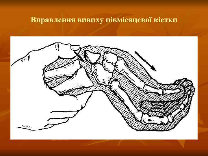 Вправлення вивиху півмісяцевої кістки 