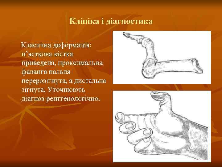    Клініка і діагностика Класична деформація: п’ясткова кістка приведена, проксимальна фаланга пальця