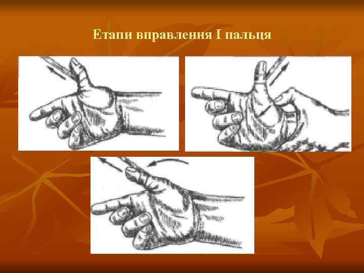Етапи вправлення Ι пальця 
