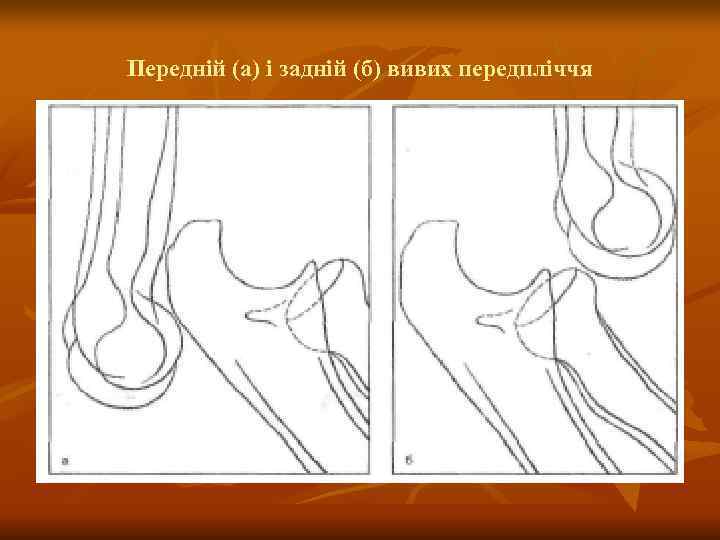 Передній (а) і задній (б) вивих передпліччя 