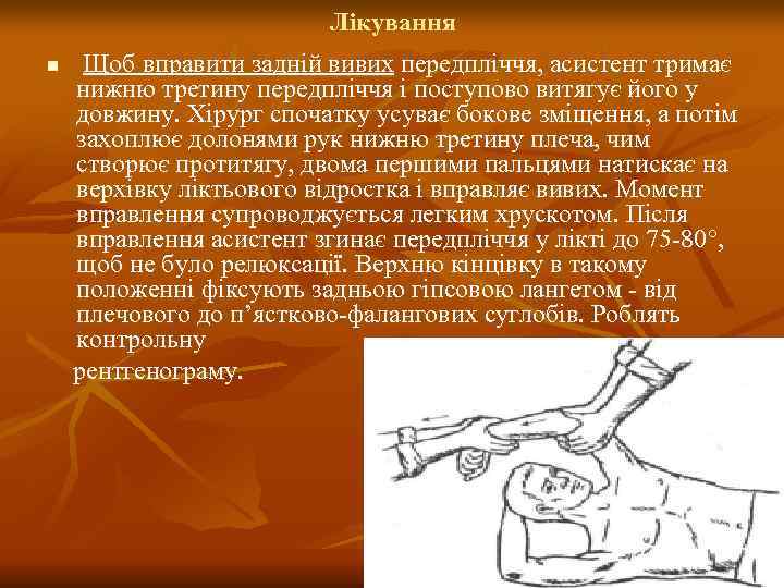      Лікування n  Щоб вправити задній вивих передпліччя, асистент
