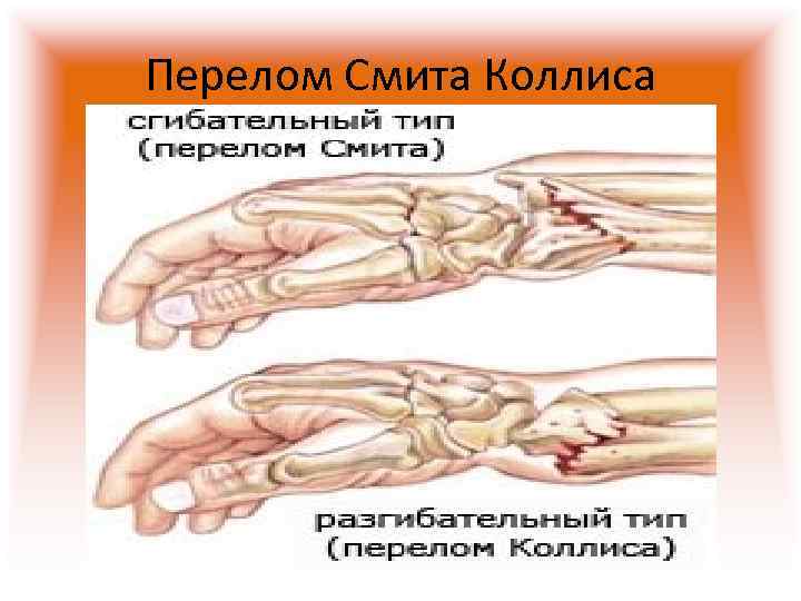 Повреждение кисти травматология презентация