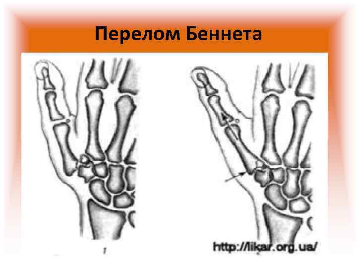 Перелом мизинца карта вызова