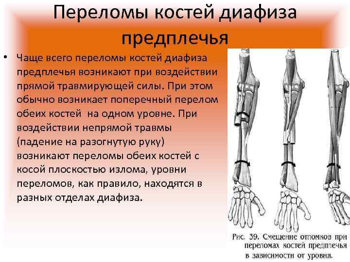 >  Переломы костей диафиза    предплечья • Чаще всего переломы костей