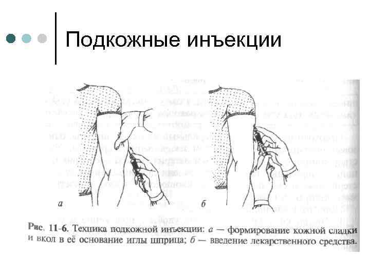 Подкожные инъекции 