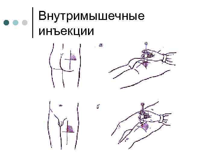 Внутримышечные инъекции 