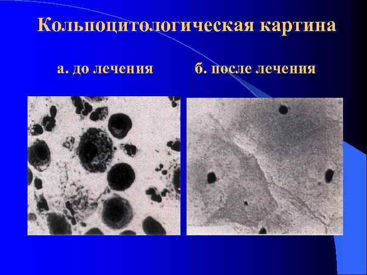 Кольпоцитологическая картина а. до лечения б. после лечения 