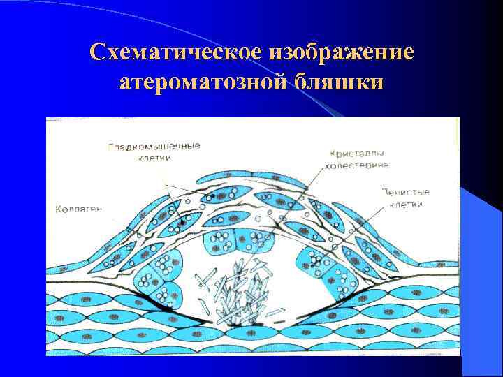 Схематическое изображение атероматозной бляшки 