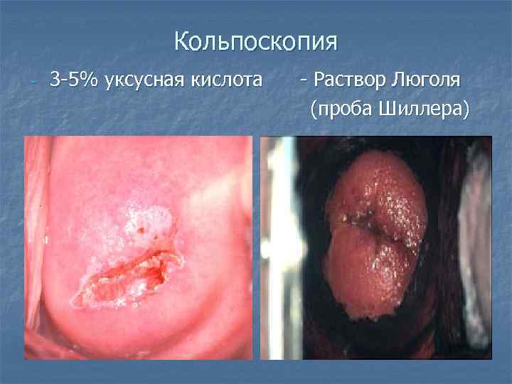     Кольпоскопия - 3 -5% уксусная кислота - Раствор Люголя 