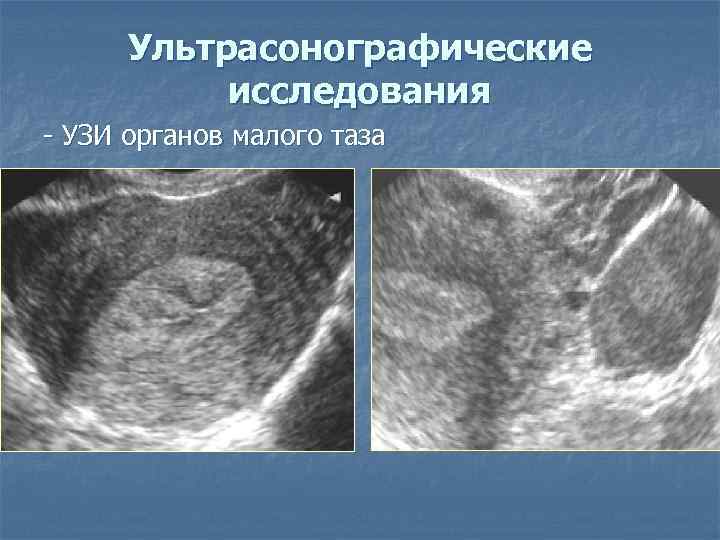  Ультрасонографические  исследования - УЗИ органов малого таза 