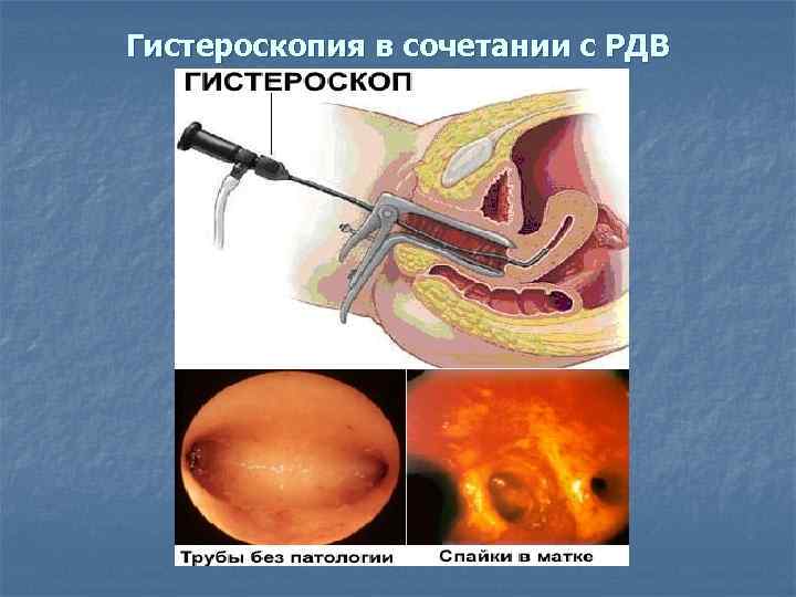 Гистероскопия в сочетании с РДВ 