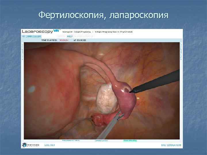 Фертилоскопия, лапароскопия 