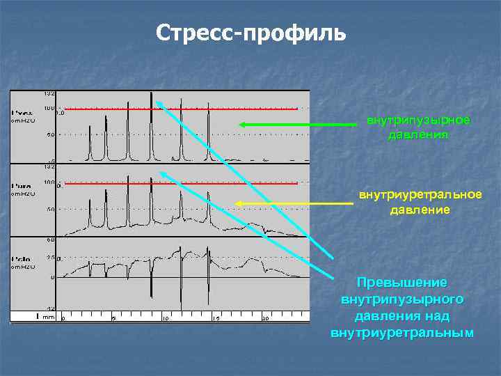 Стресс-профиль     внутрипузырное     давления   