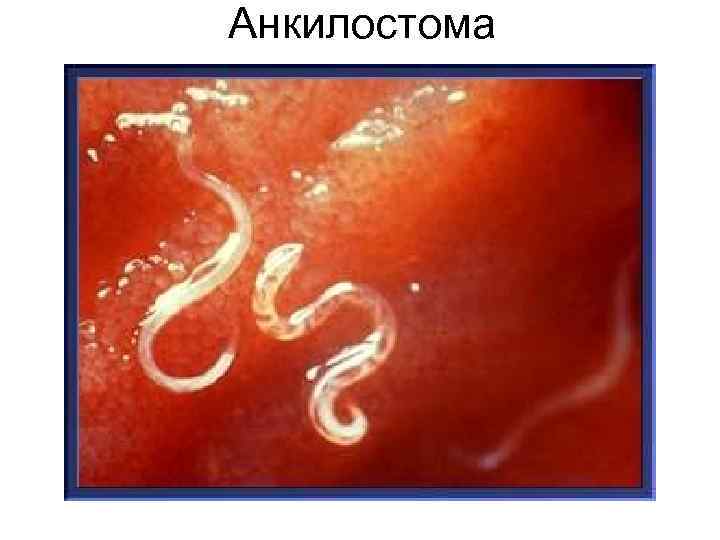 Анкилостома Анкилостома