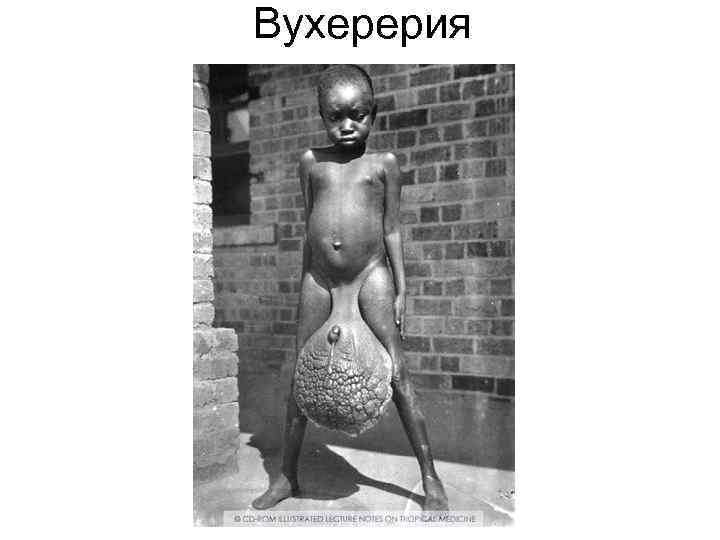Вухерерия Вухерерия
