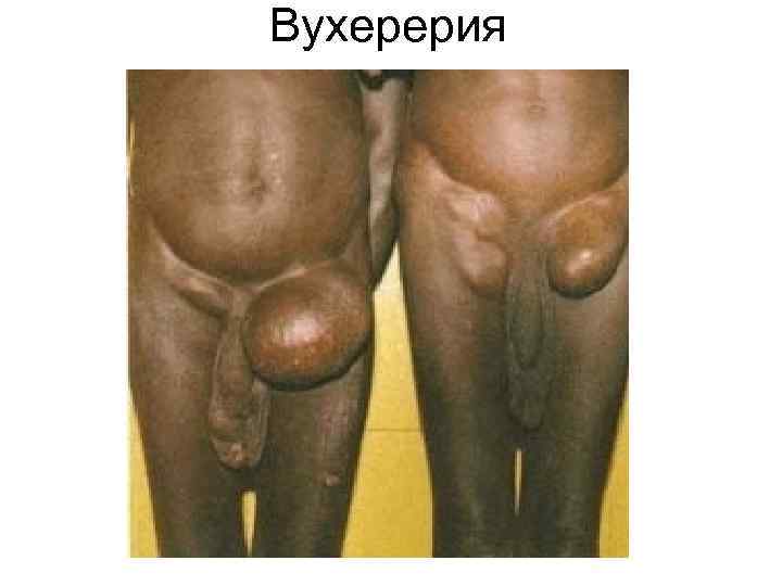 Вухерерия Вухерерия