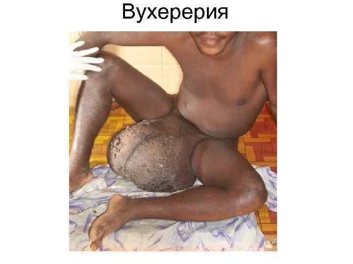Вухерерия Вухерерия