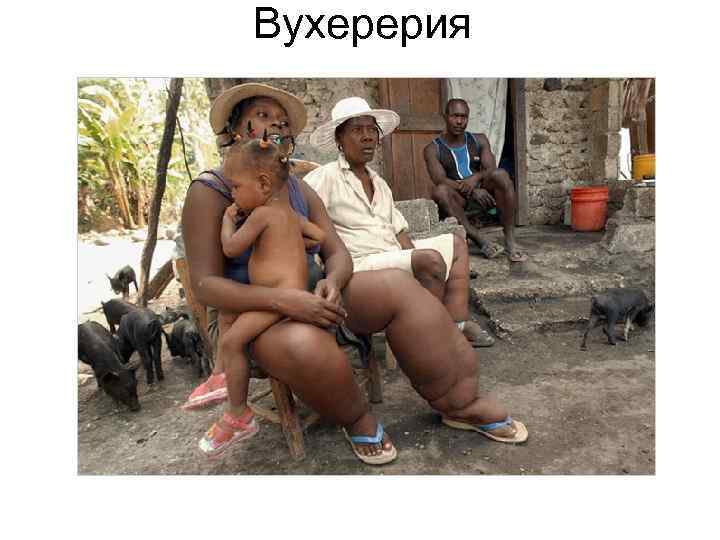 Вухерерия Вухерерия