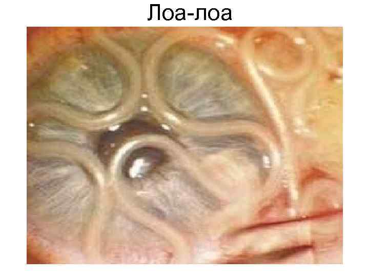 Лоа-лоа Лоа-лоа