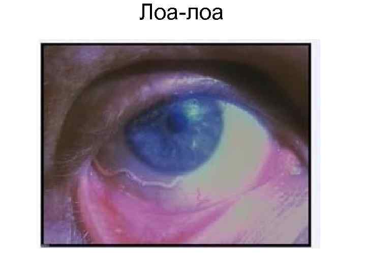 Лоа-лоа Лоа-лоа