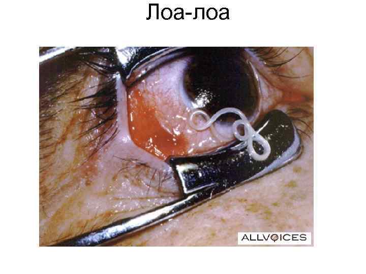 Лоа-лоа Лоа-лоа