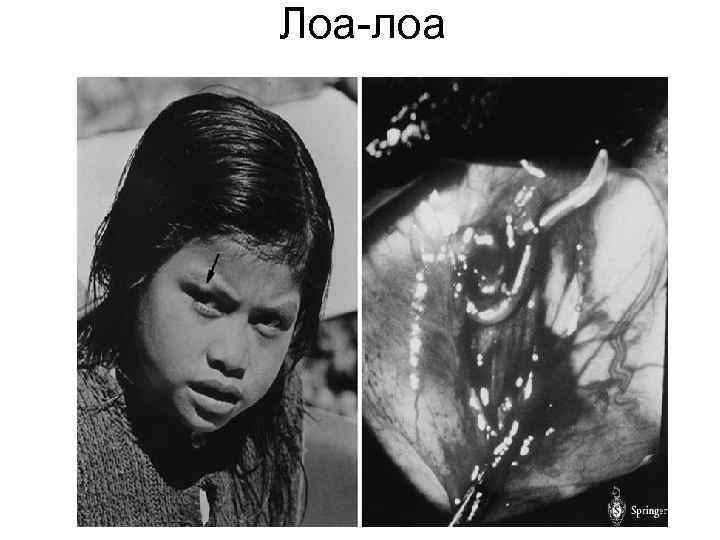 Лоа-лоа Лоа-лоа