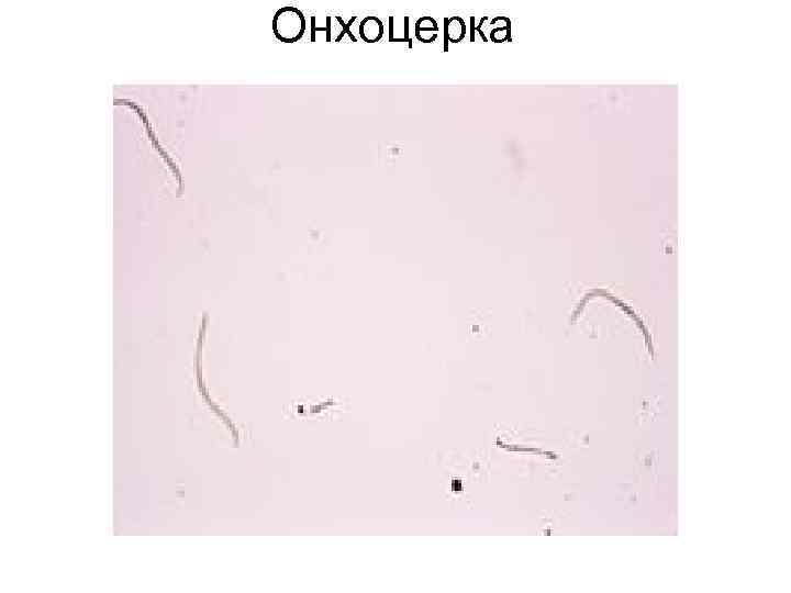 Онхоцерка Онхоцерка