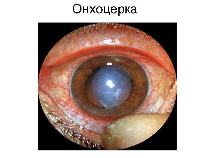 Онхоцерка Онхоцерка