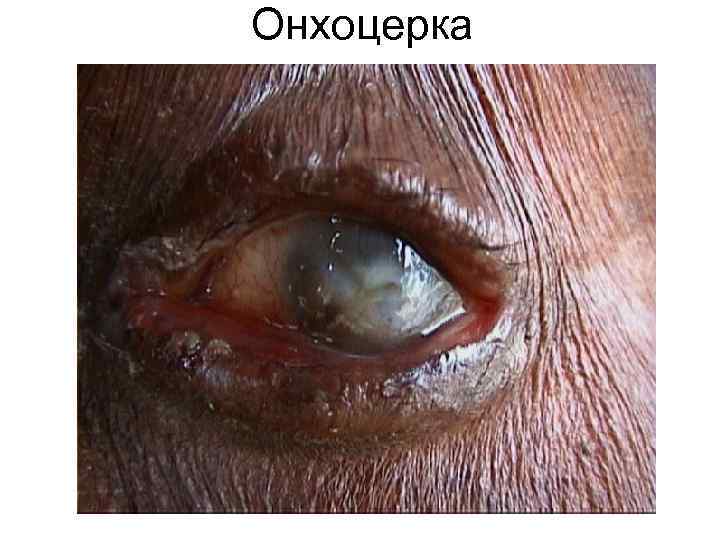 Онхоцерка Онхоцерка