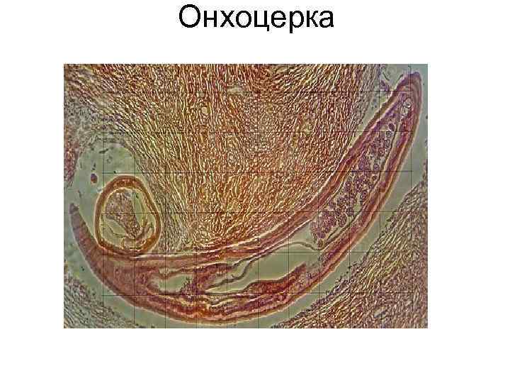 Онхоцерка Онхоцерка
