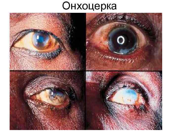 Онхоцерка Онхоцерка