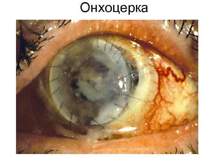 Онхоцерка Онхоцерка