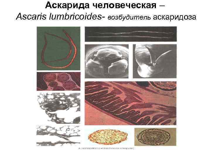 Аскарида человеческая – Ascaris lumbricoides- возбудитель аскаридоза Аскарида человеческая – Ascaris lumbricoides- возбудитель аскаридоза