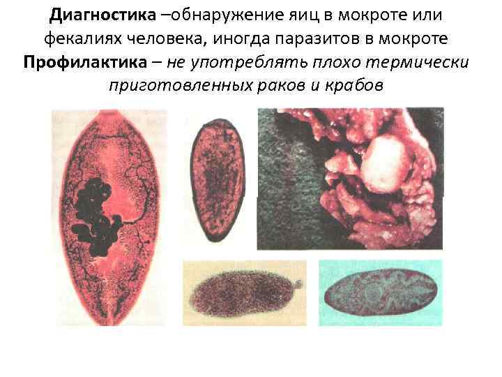 Диагностика –обнаружение яиц в мокроте или  фекалиях человека, иногда паразитов в мокроте