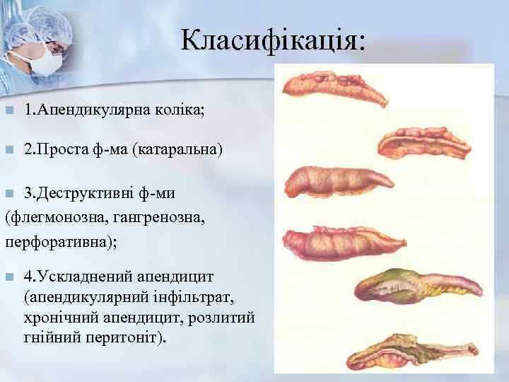     Класифікація:  n  1. Апендикулярна коліка;  n 