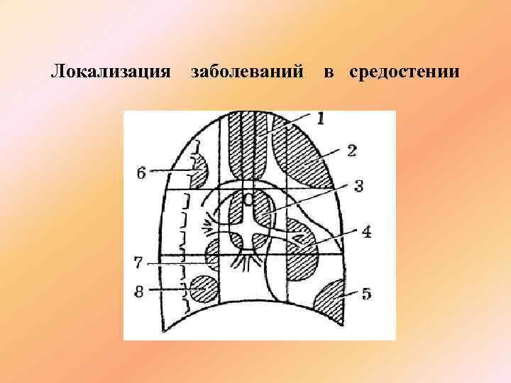 Локализация  заболеваний  в средостении 