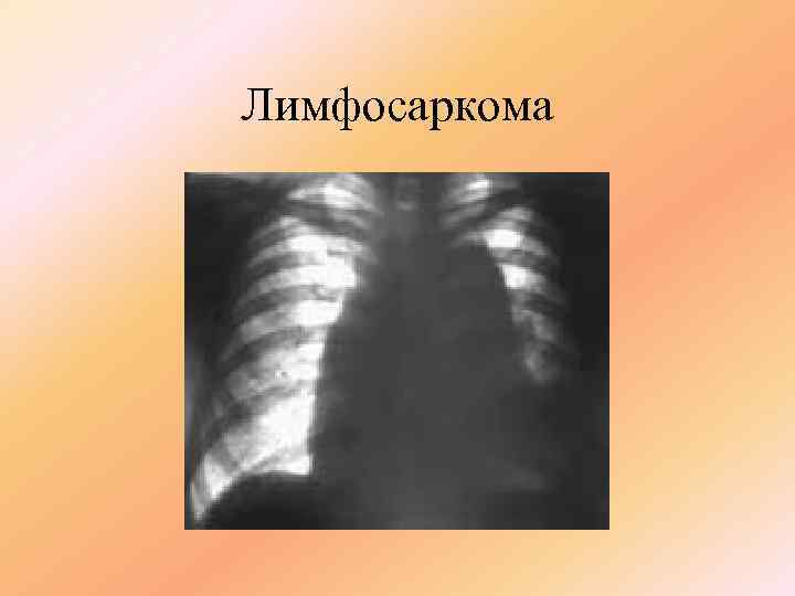 Лимфосаркома 