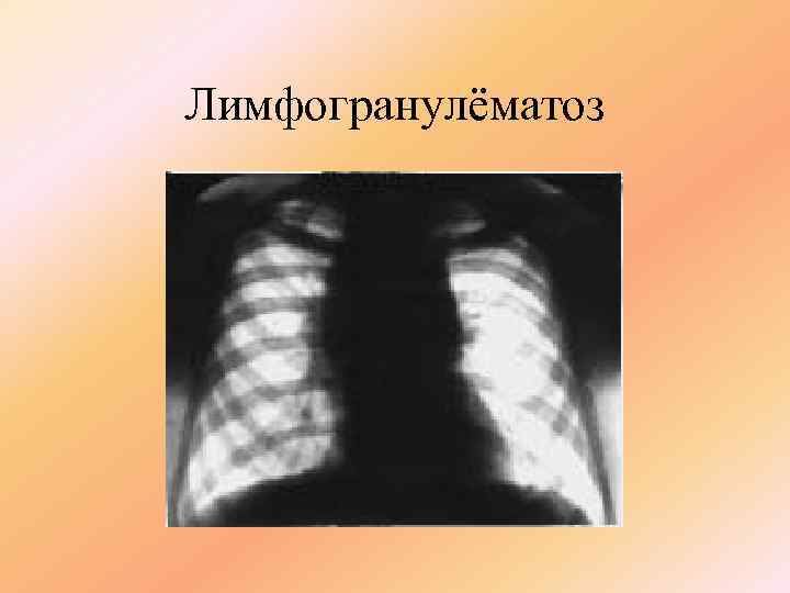 Лимфогранулёматоз 