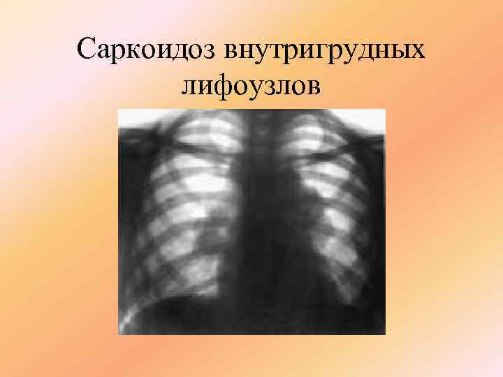 Саркоидоз внутригрудных  лифоузлов 