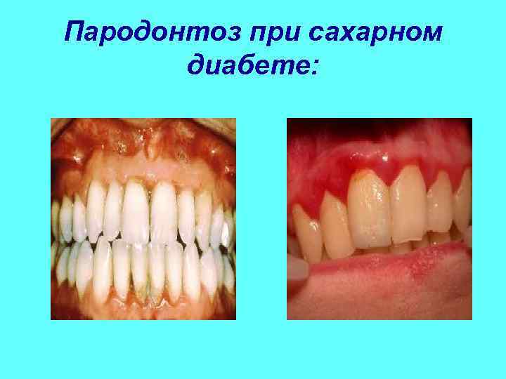 Пародонтоз при сахарном   диабете: 