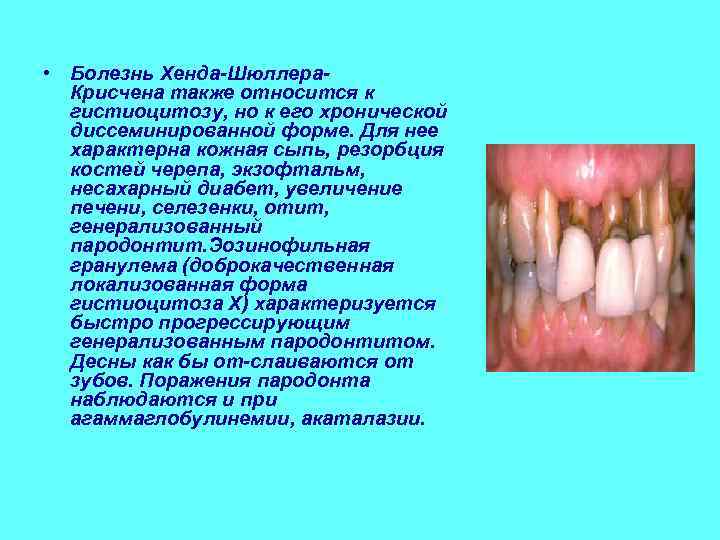  • Болезнь Хенда Шюллера  Крисчена также относится к  гистиоцитозу, но к