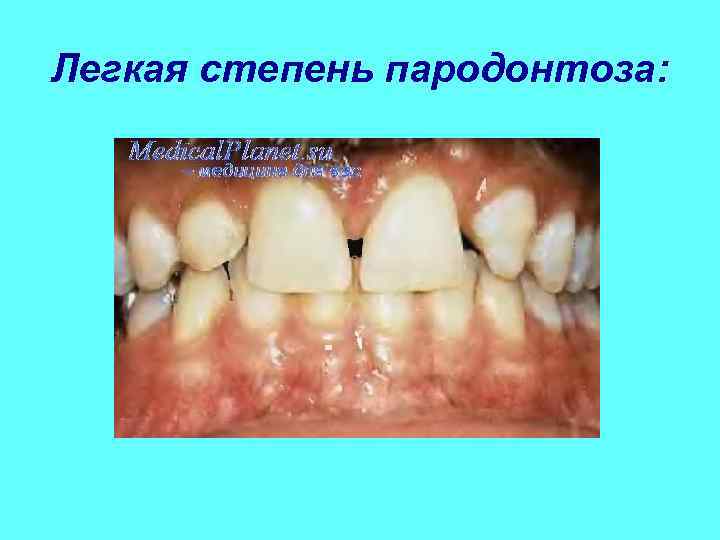 Легкая степень пародонтоза: 