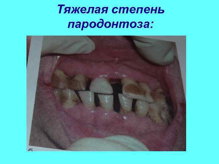 Тяжелая степень  пародонтоза: 