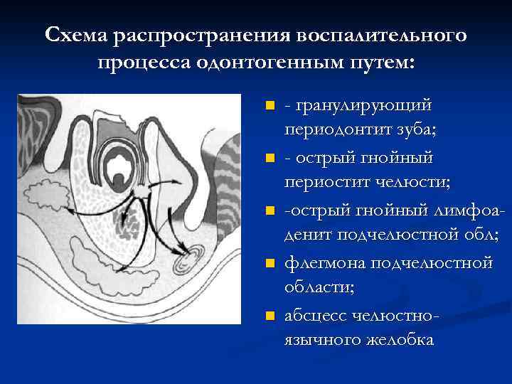 Схема распространения воспалительного процесса одонтогенным путем: n n n - гранулирующий периодонтит зуба; -