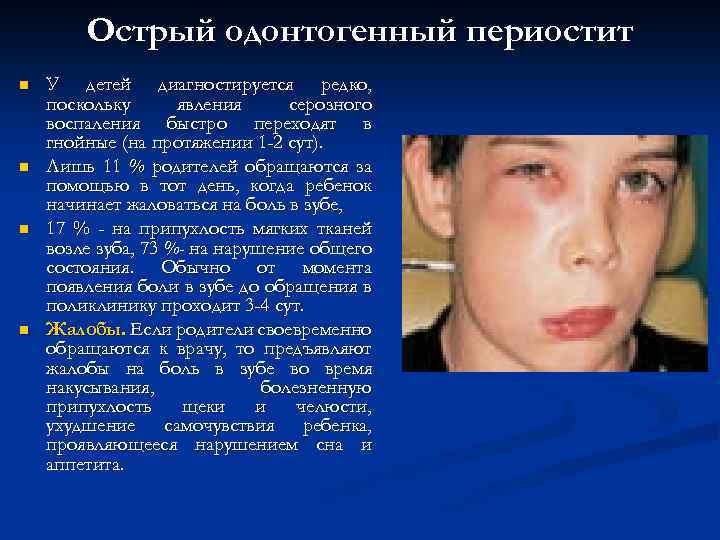 Острый одонтогенный периостит n n У детей диагностируется редко, поскольку явления серозного воспаления быстро