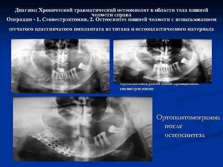 Диагноз: Хронический травматический остеомиелит в области тела нижней челюсти справа Операции - 1. Секвестрэктомия,