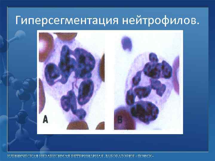 Гиперсегментация нейтрофилов. 