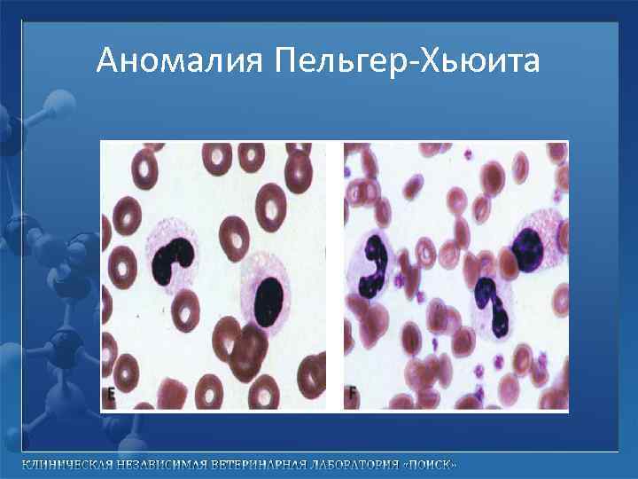 Аномалия Пельгер-Хьюита 